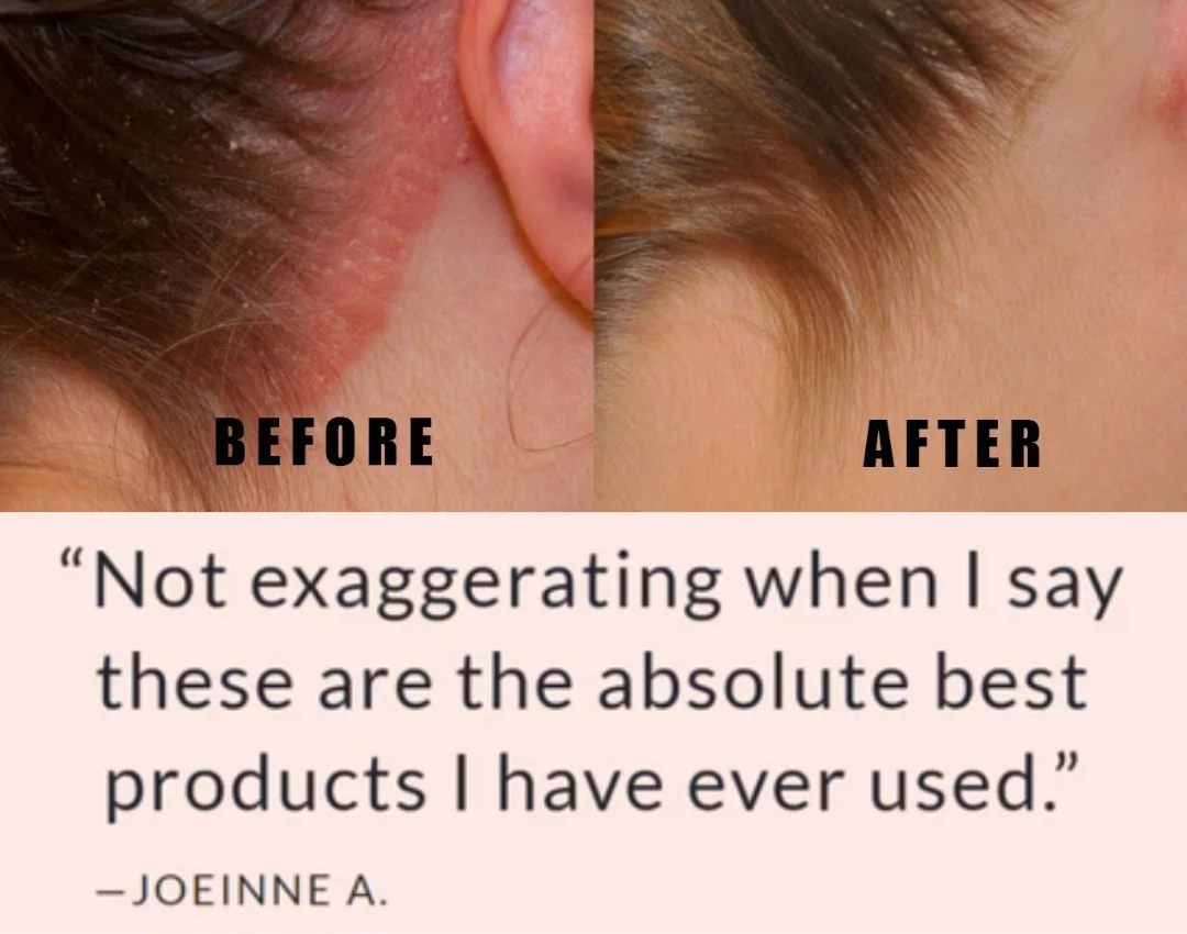 The Australian Luxury - ScalpLux + Shampoo & Conditioner Set with Batana Oil - For More Targeted Psoriasis & Itching - Image 9